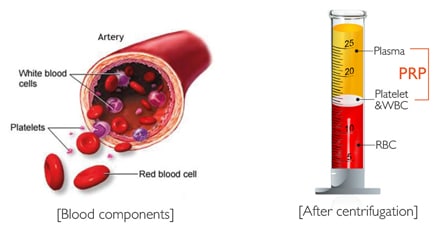 Plasma Treatment (PRP) 1 PRP Knee Injection Kingston